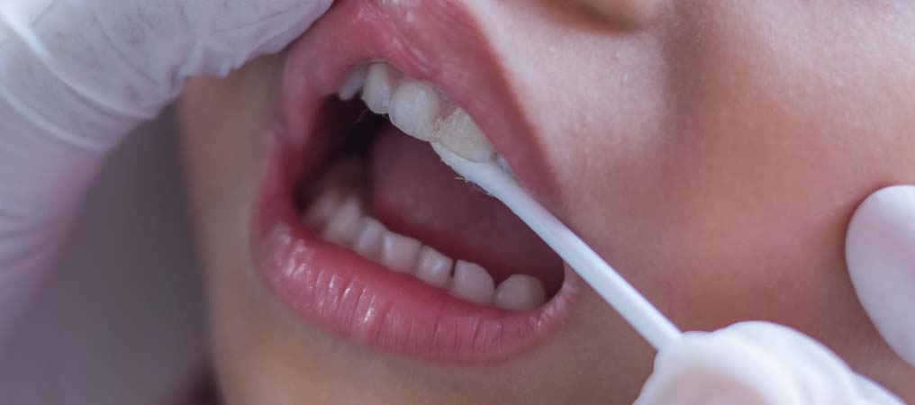 Florürlü Vernik Uygulamalarıyla Diş Çürüklerine Karşı Etkili Koruma
